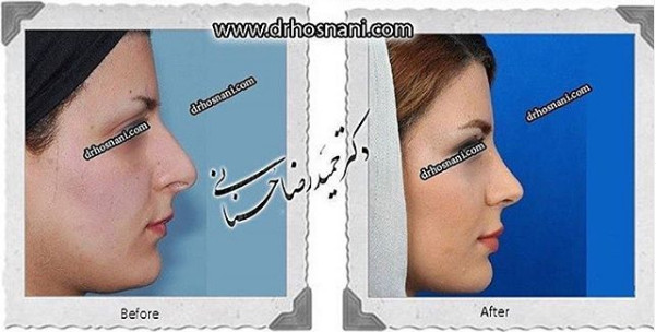 کاهش ارتفاع بینی