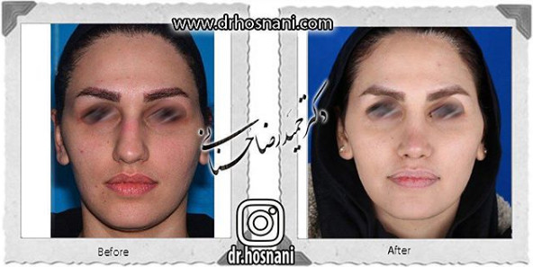 اصلاح انحراف بینی