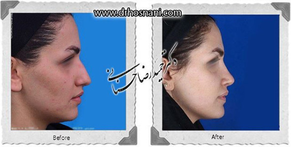 اصلاح انحراف بینی