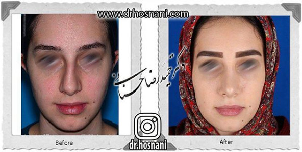 اصلاح انحراف بینی