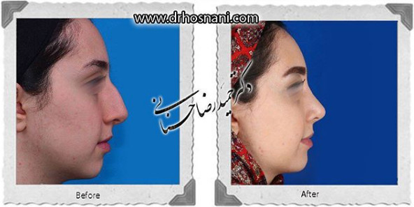 اصلاح انحراف بینی