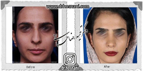 اصلاح انحراف بینی