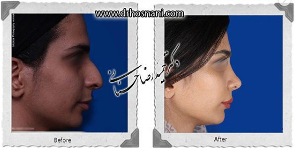 اصلاح انحراف بینی