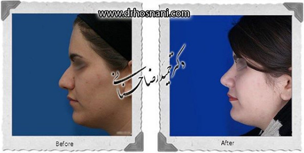  جراحی بینی -928