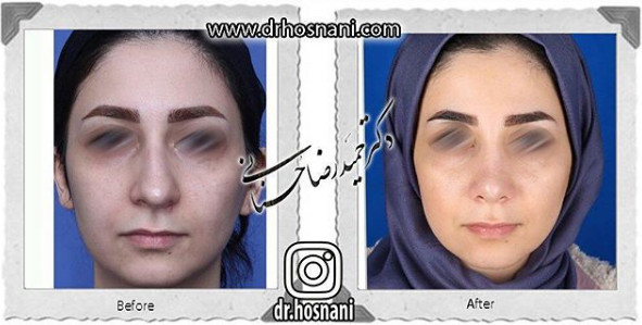اصلاح انحراف بینی