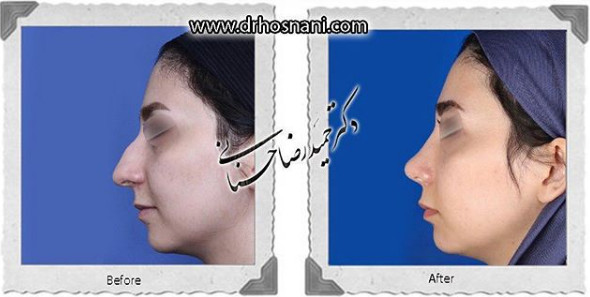 اصلاح انحراف بینی