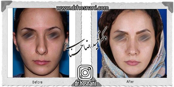 اصلاح انحراف بینی