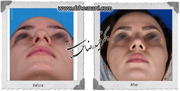 اصلاح انحراف بینی