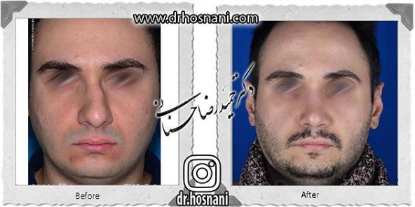 اصلاح انحراف بینی