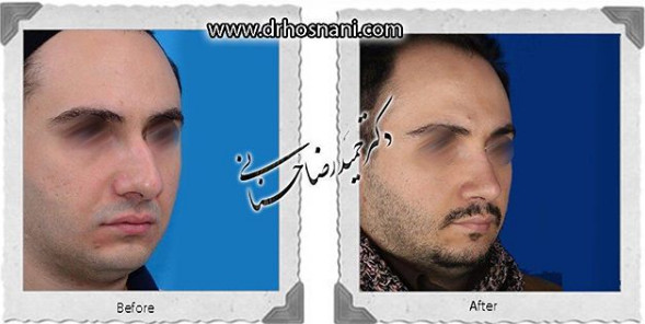 اصلاح انحراف بینی
