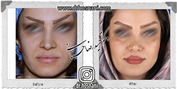 جراحی بینی