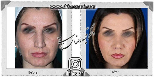 اصلاح انحراف بینی