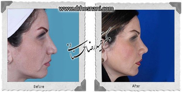 اصلاح انحراف بینی