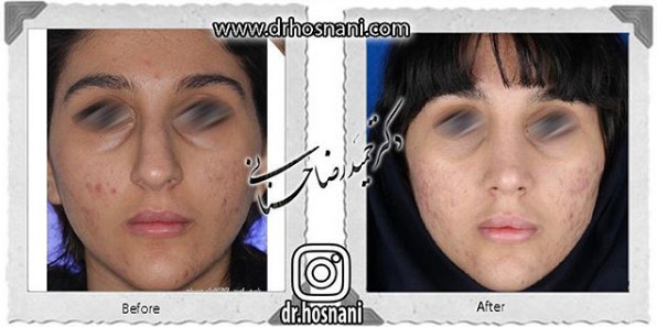 اصلاح انحراف بینی