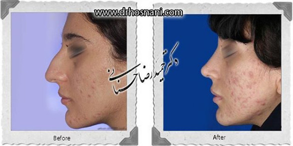اصلاح انحراف بینی