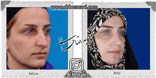 جراحی بینی
