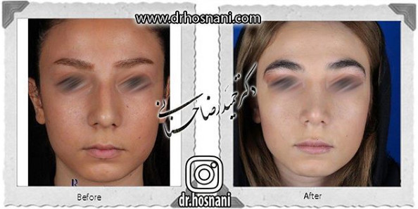 جراحی بینی
