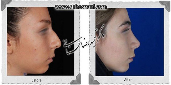 جراحی بینی