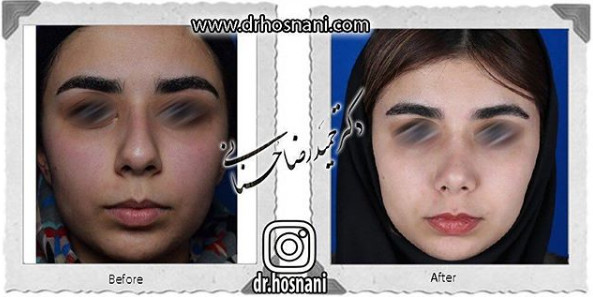  جراحی بینی -945