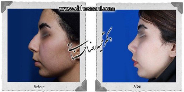  جراحی بینی -946