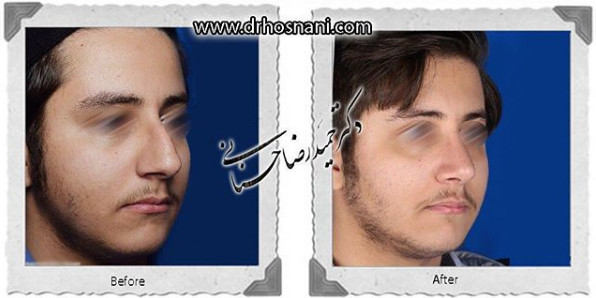 جراحی بینی