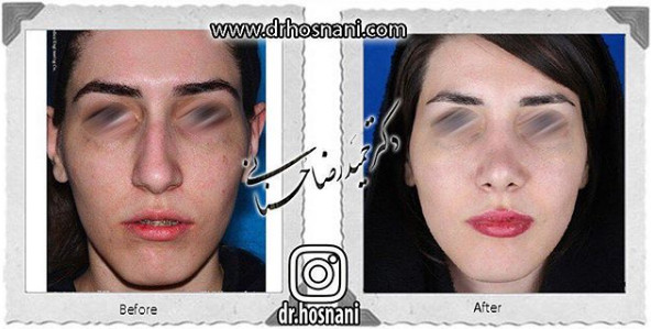 اصلاح انحراف بینی