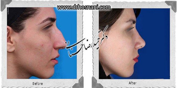 اصلاح انحراف بینی