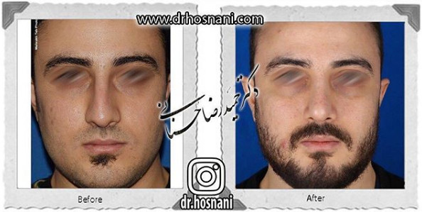 اصلاح انحراف بینی