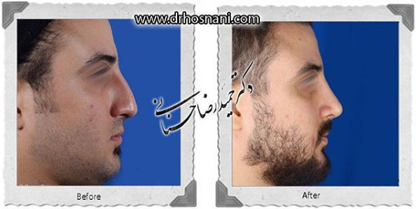 اصلاح انحراف بینی