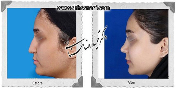 جراحی بینی