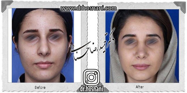 اصلاح انحراف بینی