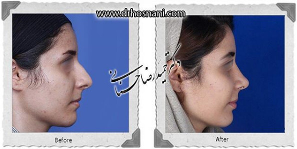 اصلاح انحراف بینی