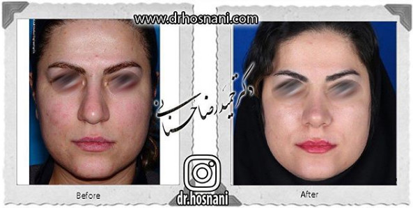 اصلاح انحراف بینی