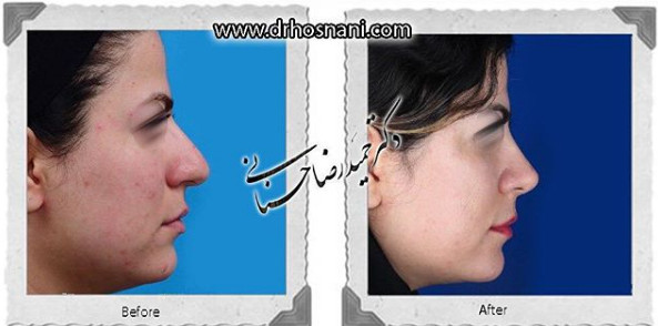 اصلاح انحراف بینی