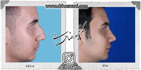  جراحی بینی -961