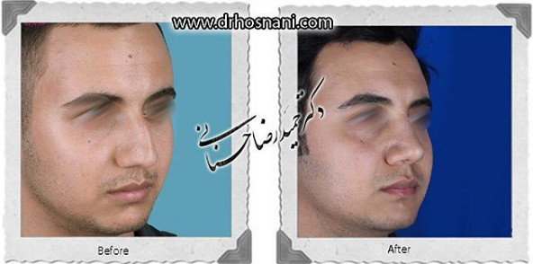  جراحی بینی -962
