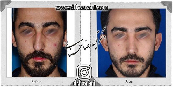 اصلاح انحراف بینی