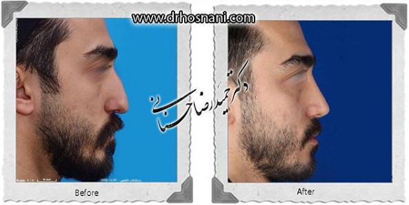 اصلاح انحراف بینی