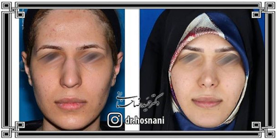 جراحی بینی