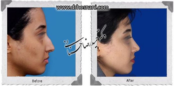 جراحی بینی