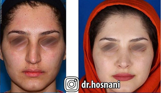 اصلاح انحراف بینی