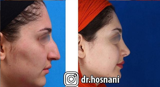 اصلاح انحراف بینی