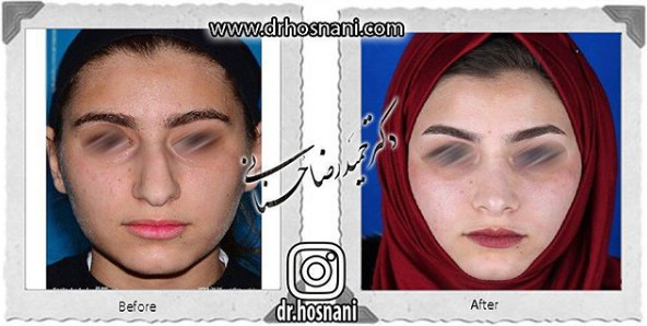 اصلاح انحراف بینی