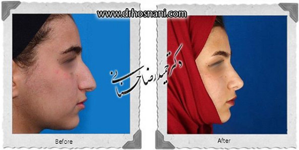 اصلاح انحراف بینی