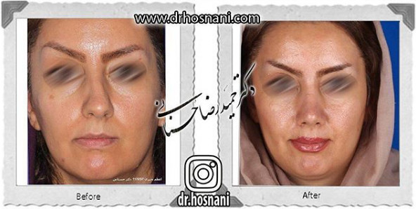 اصلاح انحراف بینی