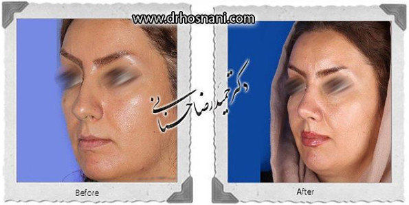 اصلاح انحراف بینی