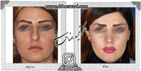 جراحی بینی