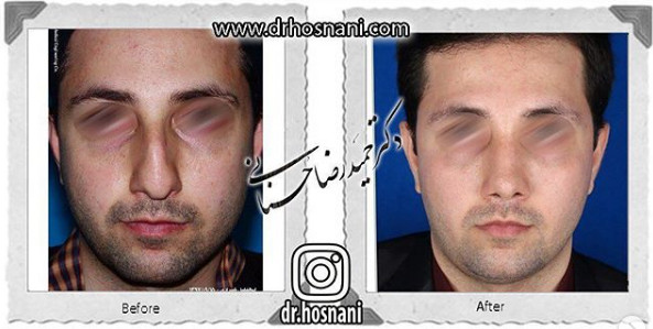 اصلاح انحراف بینی