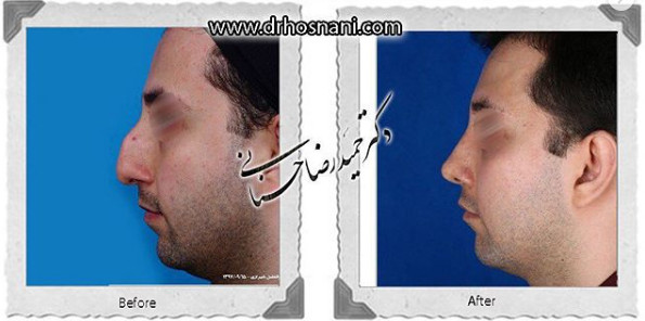 اصلاح انحراف بینی