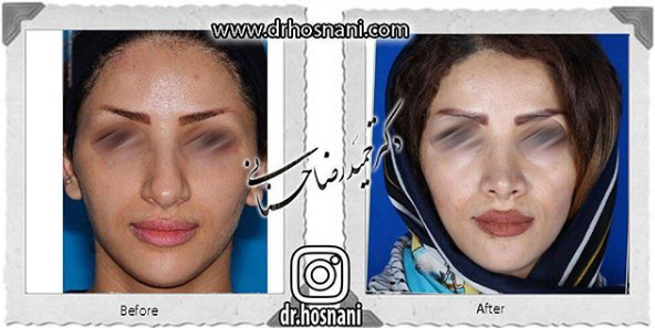 جراحی بینی